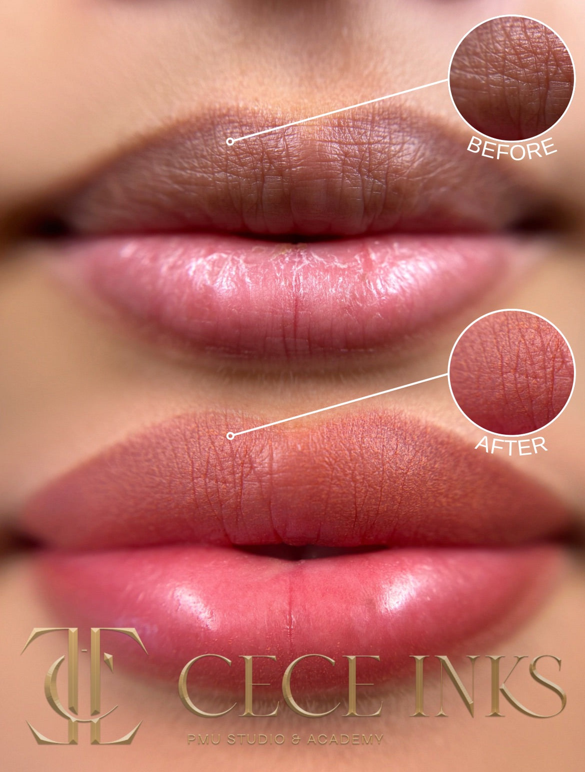 Dark Lip Neutralization