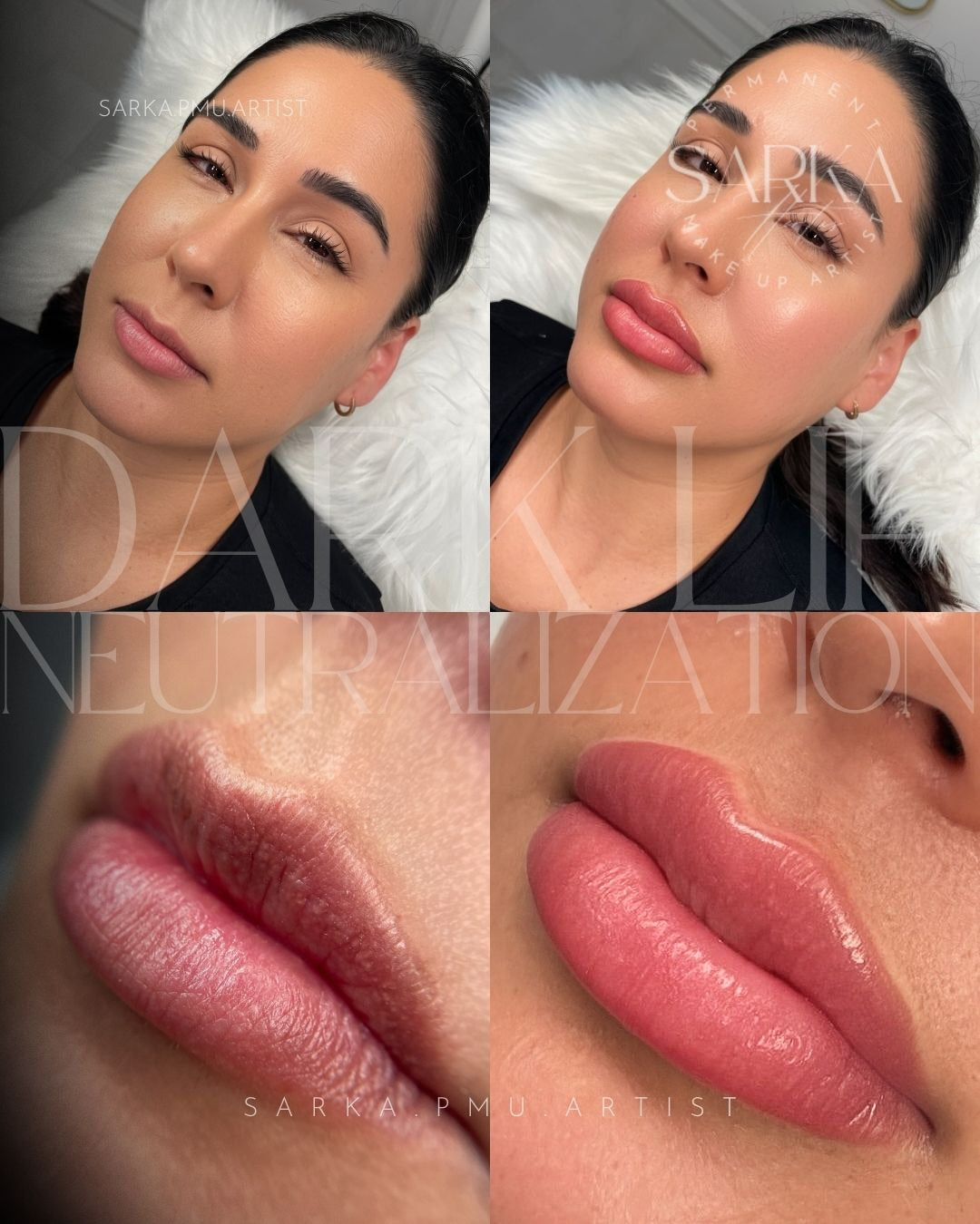 Dark Lip Neutralization