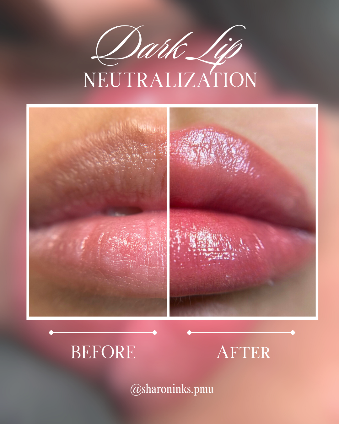 Dark Lip Neutralization